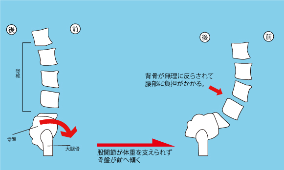 股関節と腰痛