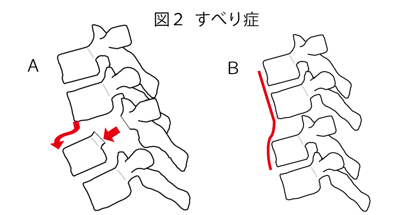 すべり症