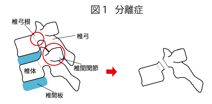 分離症