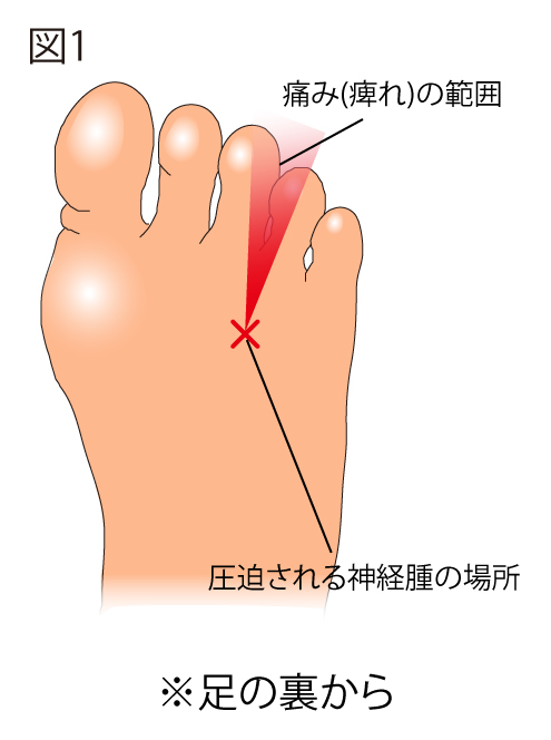 モートン病１