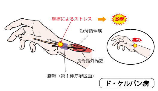 ドケルバン