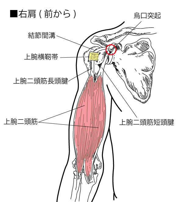 上腕二頭筋長頭腱炎