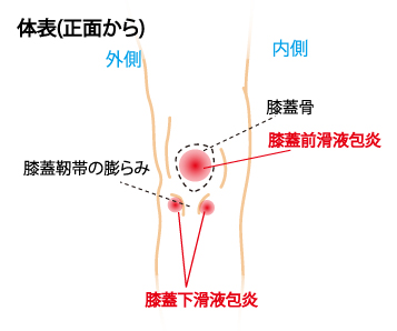 膝蓋前滑液包炎 お皿の上が腫れる やすらぎ整骨院 長岡京市