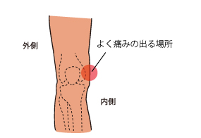 内側側副靱帯　痛みの場所