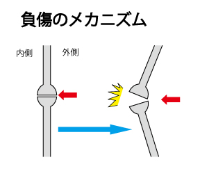 内側側副靱帯　受傷メカニズム