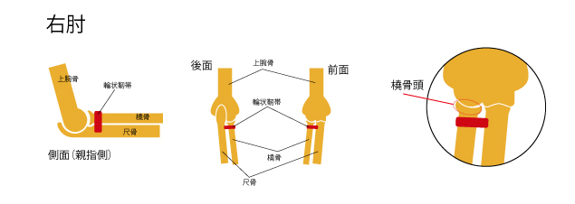 肘内障１