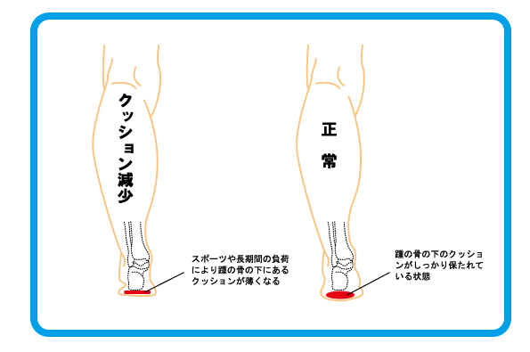 踵骨棘　２