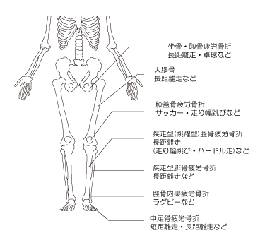 疲労骨折　下半身